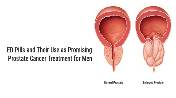 ED Pills and Their Use as Promising Prostate Cancer Treatment for Men