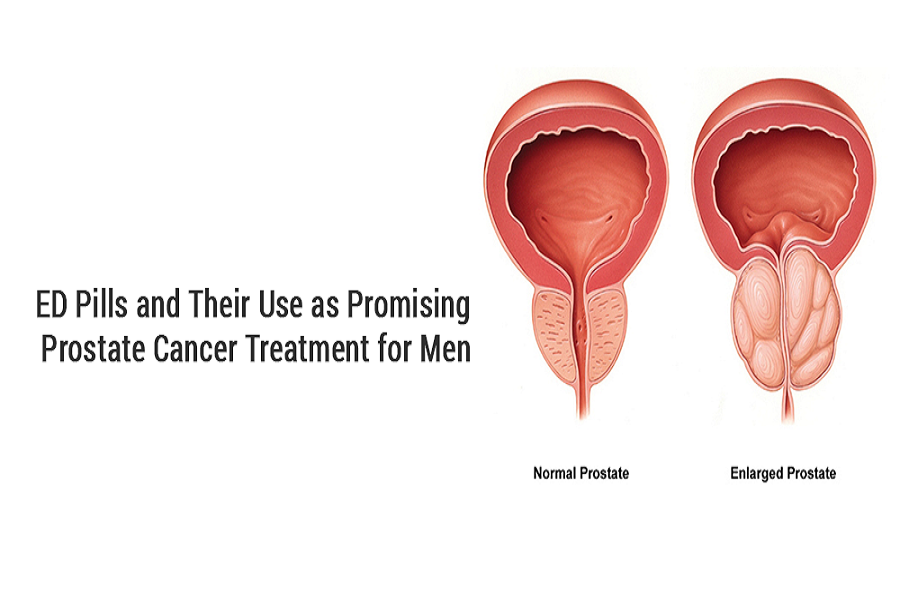 ED Pills and Their Use as Promising Prostate Cancer Treatment for Men